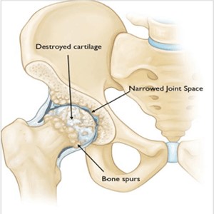 Childhood hip disease