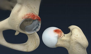 Femoro Acetabular Impingement (FAI)