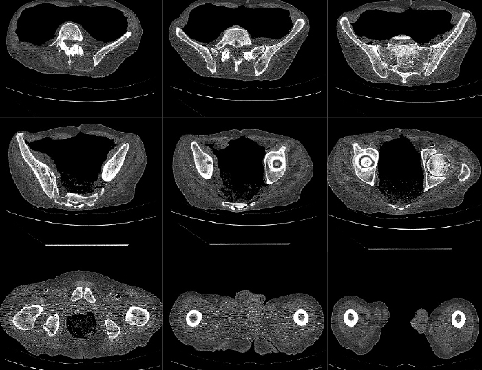 Hip CT Scan