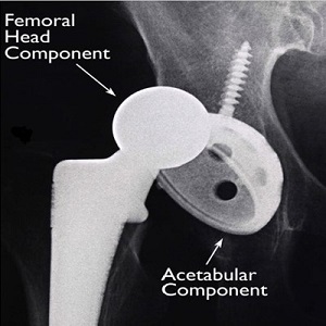 Hip implant dislocation