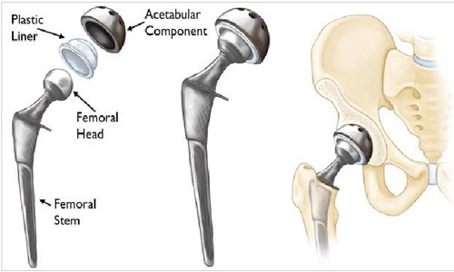 Individual Components of a Total Hip Replacement