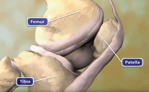 Knee arthritis