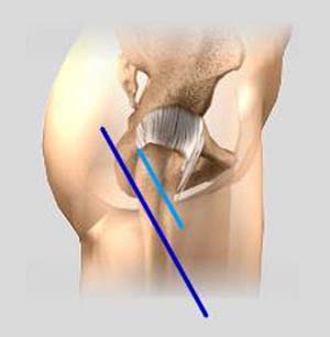 Minimally Invasive Hip Replacement