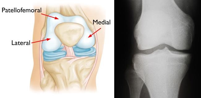 Normal & x-ray of knee joint