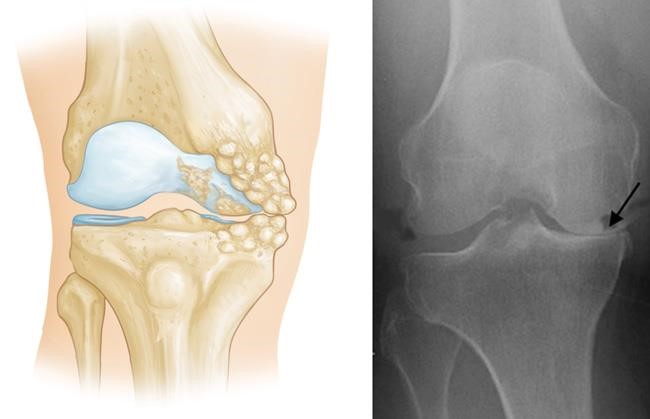 Normal & x-ray of osteoarthritis