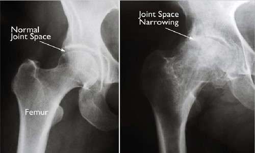 Normal and xray loss of joint space