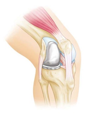 Partial Knee Replacement