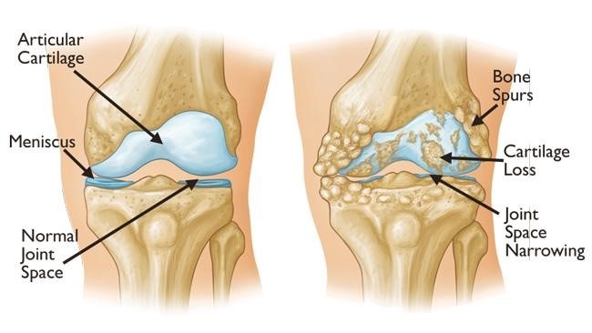 Post-traumatic arthritis