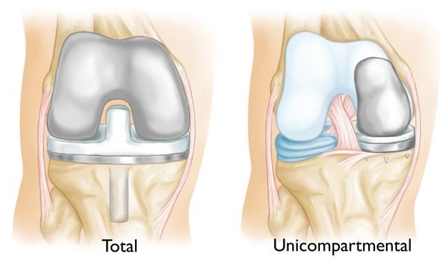 Total and Unicompartmental Knee