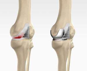 Uni Condylar Knee Replacement