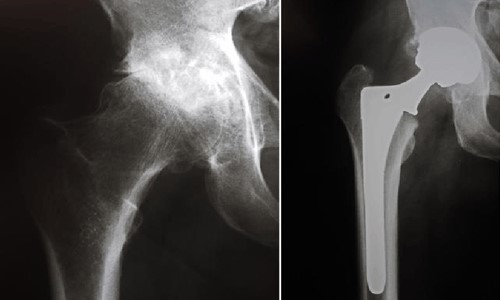 X-rays before and after total hip replacement