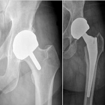 x-ray of a hip resurfacing