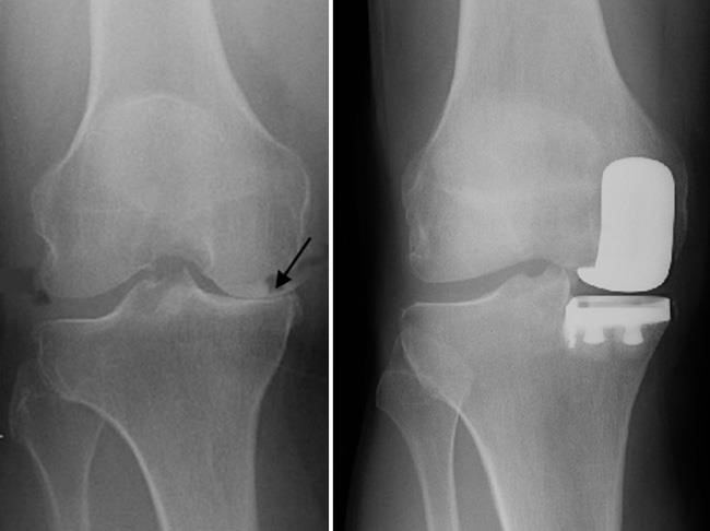X-ray partial knee replacement implant